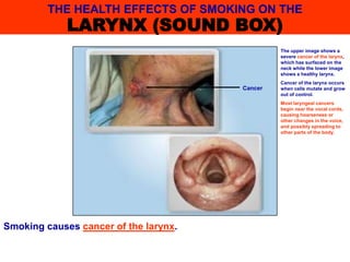Smoking causes cancer of the larynx.
The upper image shows a
severe cancer of the larynx,
which has surfaced on the
neck while the lower image
shows a healthy larynx.
Cancer of the larynx occurs
when cells mutate and grow
out of control.
Most laryngeal cancers
begin near the vocal cords,
causing hoarseness or
other changes in the voice,
and possibly spreading to
other parts of the body.
THE HEALTH EFFECTS OF SMOKING ON THE
LARYNX (SOUND BOX)
Cancer
 