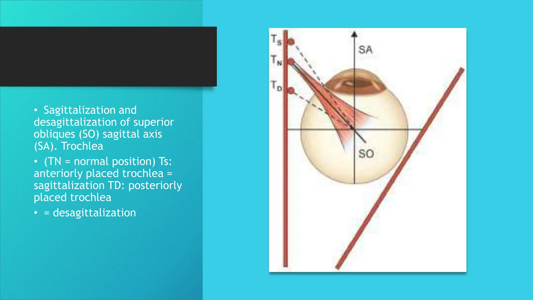 • Sagittalization and
desagittalization of superior
obliques (SO) sagittal axis
(SA). Trochlea
• (TN = normal position) Ts:
anteriorly placed trochlea =
sagittalization TD: posteriorly
placed trochlea
• = desagittalization
 