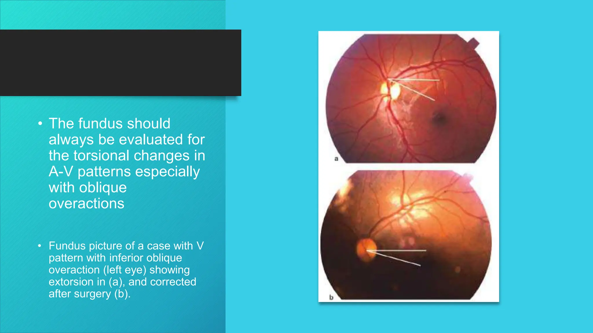 • The fundus should
always be evaluated for
the torsional changes in
A-V patterns especially
with oblique
overactions
• Fundus picture of a case with V
pattern with inferior oblique
overaction (left eye) showing
extorsion in (a), and corrected
after surgery (b).
 