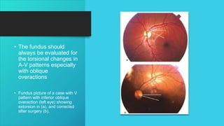 • The fundus should
always be evaluated for
the torsional changes in
A-V patterns especially
with oblique
overactions
• Fundus picture of a case with V
pattern with inferior oblique
overaction (left eye) showing
extorsion in (a), and corrected
after surgery (b).
 