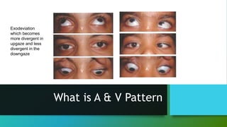 What is A & V Pattern
Exodeviation
which becomes
more divergent in
upgaze and less
divergent in the
downgaze
V
V
A
A
 