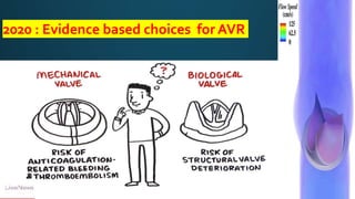 2020 : Evidence based choices for AVR
 