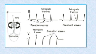 Avrt and avnrt | PPTX
