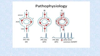 Avrt and avnrt | PPTX