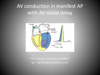 AV conduction in manifest AP
with AV nodal delay
Vn – normal ventricular activation
Vp – ventricular activation via AP
 
