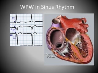 WPW in Sinus Rhythm
 