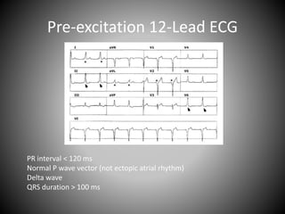 Pre-excitation 12-Lead ECG
PR interval < 120 ms
Normal P wave vector (not ectopic atrial rhythm)
Delta wave
QRS duration > 100 ms
 