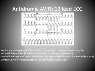 Antidromic AVRT: 12 lead ECG
Ventricular rate typically 150 – 250/min (or greater) beats per minute, regular
Wide QRS complexes (similar or wider than baseline pre-excitation)
Inverted P waves with an RP interval usually >50% the tachycardia RR interval (RP > PR)
Constant RP interval regardless of the tachycardia cycle length
 