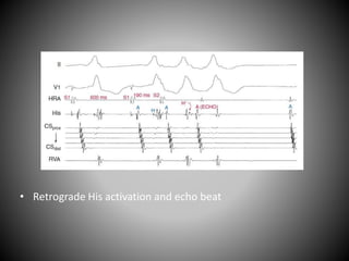 • Retrograde His activation and echo beat
 