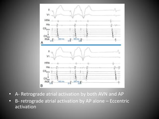 • A- Retrograde atrial activation by both AVN and AP
• B- retrograde atrial activation by AP alone – Eccentric
activation
 