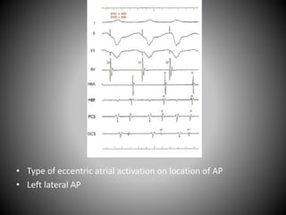• Type of eccentric atrial activation on location of AP
• Left lateral AP
 