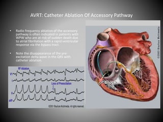 AVRT: Catheter Ablation Of Accessory Pathway
• Radio frequency ablation of the accessory
pathway is often indicated in patients with
WPW who are at risk of sudden death due
to atrial fibrillation with a rapid ventricular
response via the bypass tract.
• Note the disappearance of the pre-
excitation delta wave in the QRS with
catheter ablation.
 