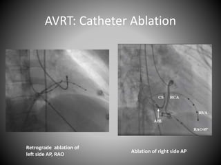 AVRT: Catheter Ablation
Retrograde ablation of
left side AP, RAO
Ablation of right side AP
 