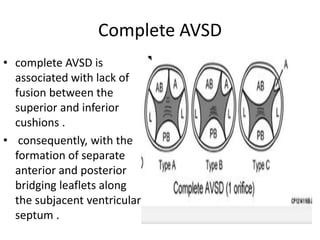 Complete AVSD
• complete AVSD is
  associated with lack of
  fusion between the
  superior and inferior
  cushions .
• consequently, with the
  formation of separate
  anterior and posterior
  bridging leaflets along
  the subjacent ventricular
  septum .
 