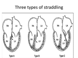 Three types of straddling
 