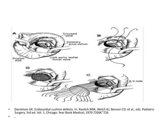 •   Danielson GK. Endocardial cushion defects. In: Ravitch MM, Welch KJ, Benson CD, et al., eds. Pediatric
    Surgery. 3rd ed. Vol. 1. Chicago: Year Book Medical, 1979:720â€“726
•   ,
 
