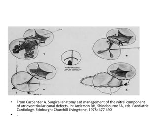 •   From Carpentier A. Surgical anatomy and management of the mitral component
    of atrioventricular canal defects. In: Anderson RH, Shinebourne EA, eds. Paediatric
    Cardiology. Edinburgh: Churchill Livingstone, 1978: 477 490
•   ,
 