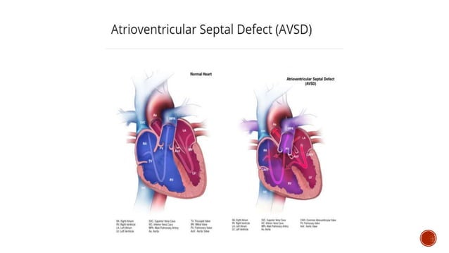 AVSD.pptx | Pregnancy | Reproductive Health