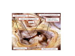 AV septal defects (AVCD) | PPT