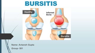 BURSITIS
Name- Avtansh Gupta
Group- 501
 