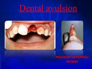 Dental avulsion
PRAVEEN KATEPOGUPRAVEEN KATEPOGU
INTERNINTERN
 