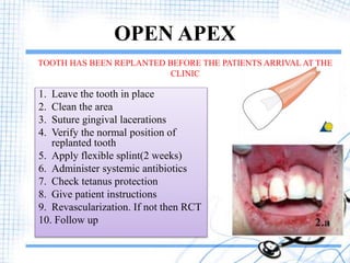 Avulsion | PPTX