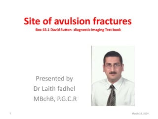 Site of avulsion fractures
Box 43.1 David Sutton- diagnostic imaging Text book
Presented by
Dr Laith fadhel
MBchB, P.G.C.R
March 18, 20141
 