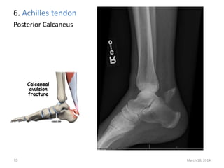 6. Achilles tendon
Posterior Calcaneus
March 18, 201410
 
