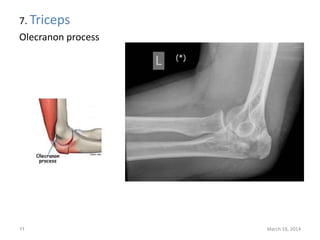 7. Triceps
Olecranon process
March 18, 201411
 
