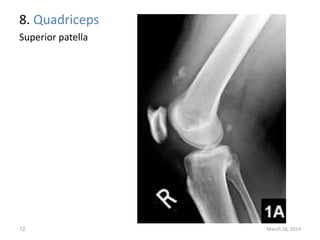 8. Quadriceps
Superior patella
March 18, 201412
 