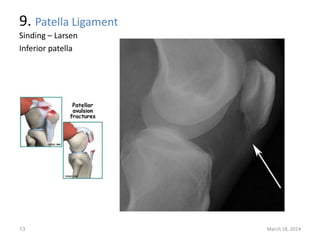 9. Patella Ligament
Sinding – Larsen
Inferior patella
March 18, 201413
 