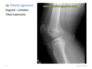 10. Patella ligament
Osgood – schlatter
Tibial tuberosity
March 18, 201414
 