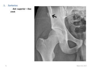 1. Sartorius
Ant -superior – iliac
crest
March 18, 20145
 