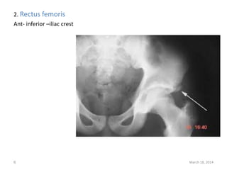2. Rectus femoris
Ant- inferior –iliac crest
March 18, 20146
 