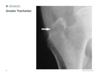 4. Gluteals
Greater Trochanter
March 18, 20148
 