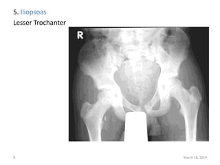5. Iliopsoas
Lesser Trochanter
March 18, 20149
 