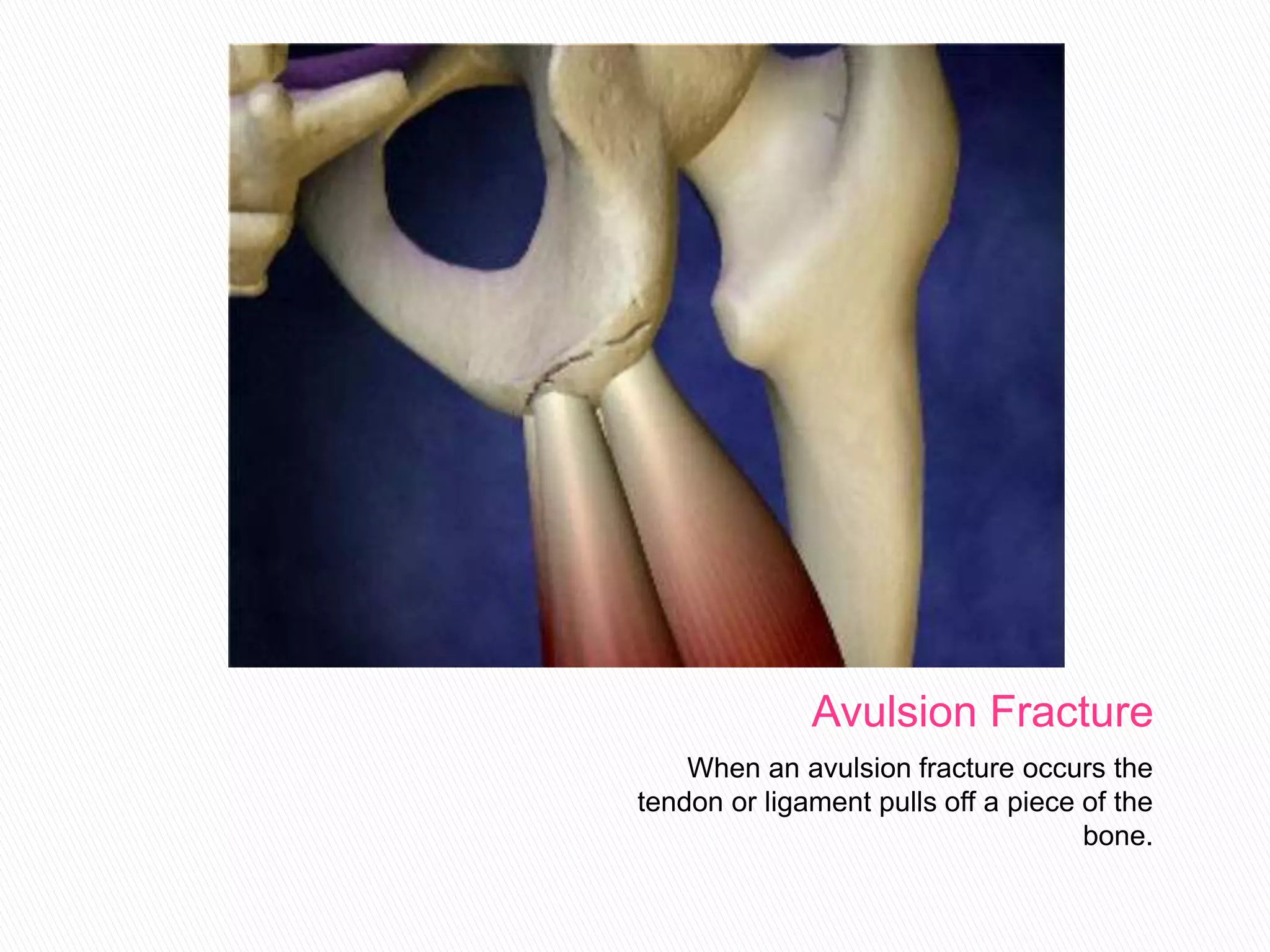 Avulsion fractures ppt [1] | PPTX