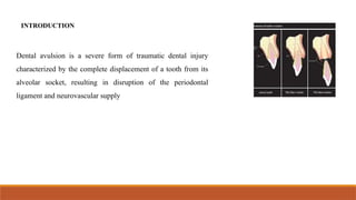 Tooth Avulsion Project treatment of delayed replanted avulsed teeth | PPTX
