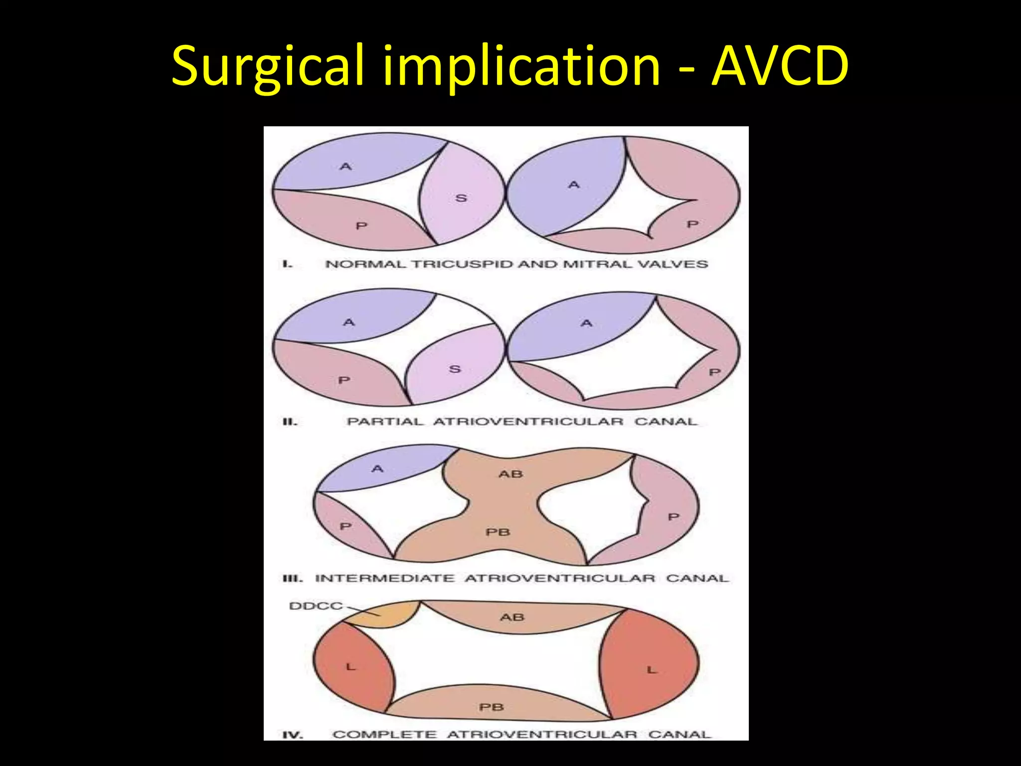 Atrioventricular valves (Mitral and Tricuspid) - Surgical anatomy | PPTX