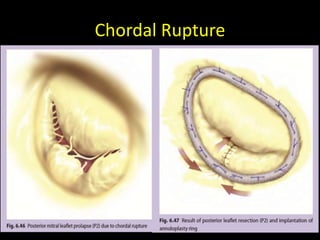 Atrioventricular valves (Mitral and Tricuspid) - Surgical anatomy | PPTX