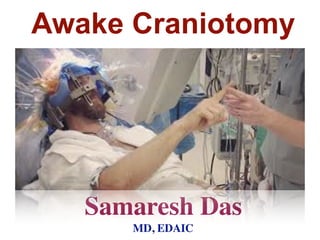 Awake Craniotomy
Samaresh Das
MD, EDAIC
 