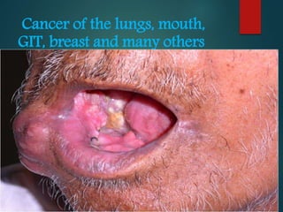 Cancer of the lungs, mouth,
GIT, breast and many others
 