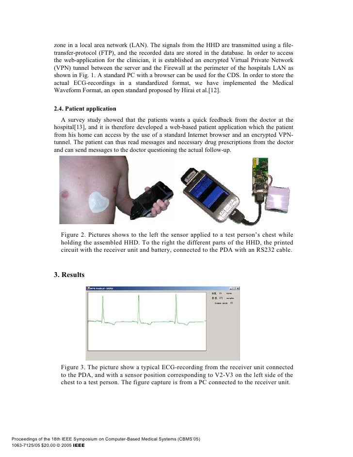 A wearable ecg recording system for continuous arrhythmia
