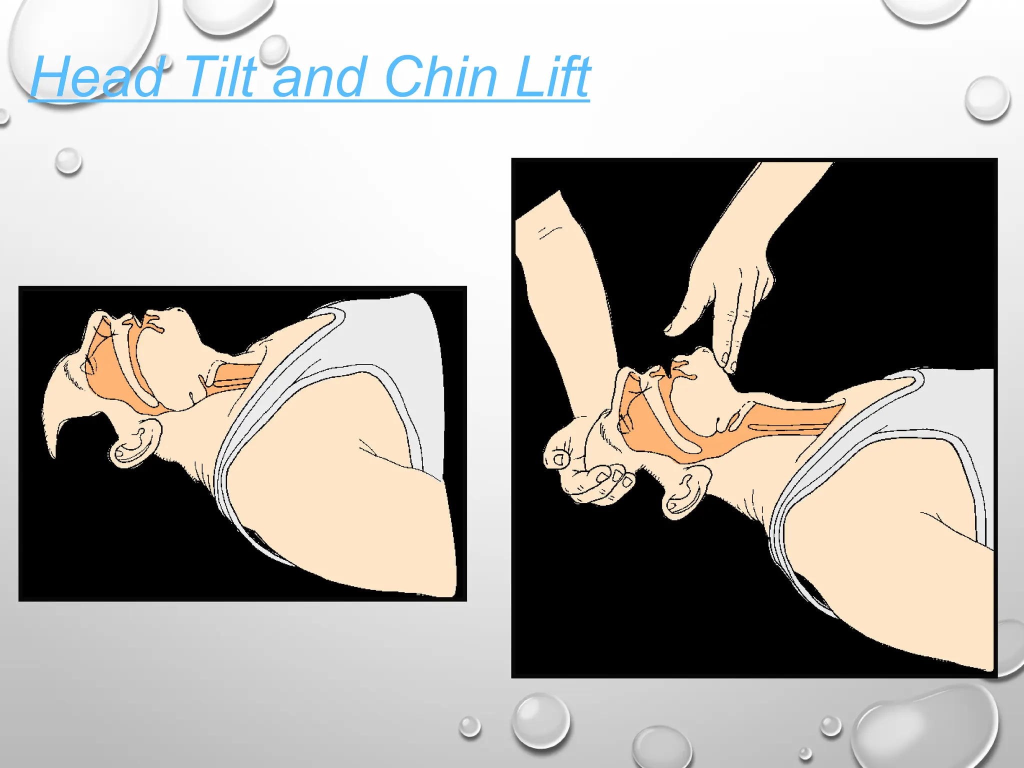 Head Tilt and Chin Lift
 