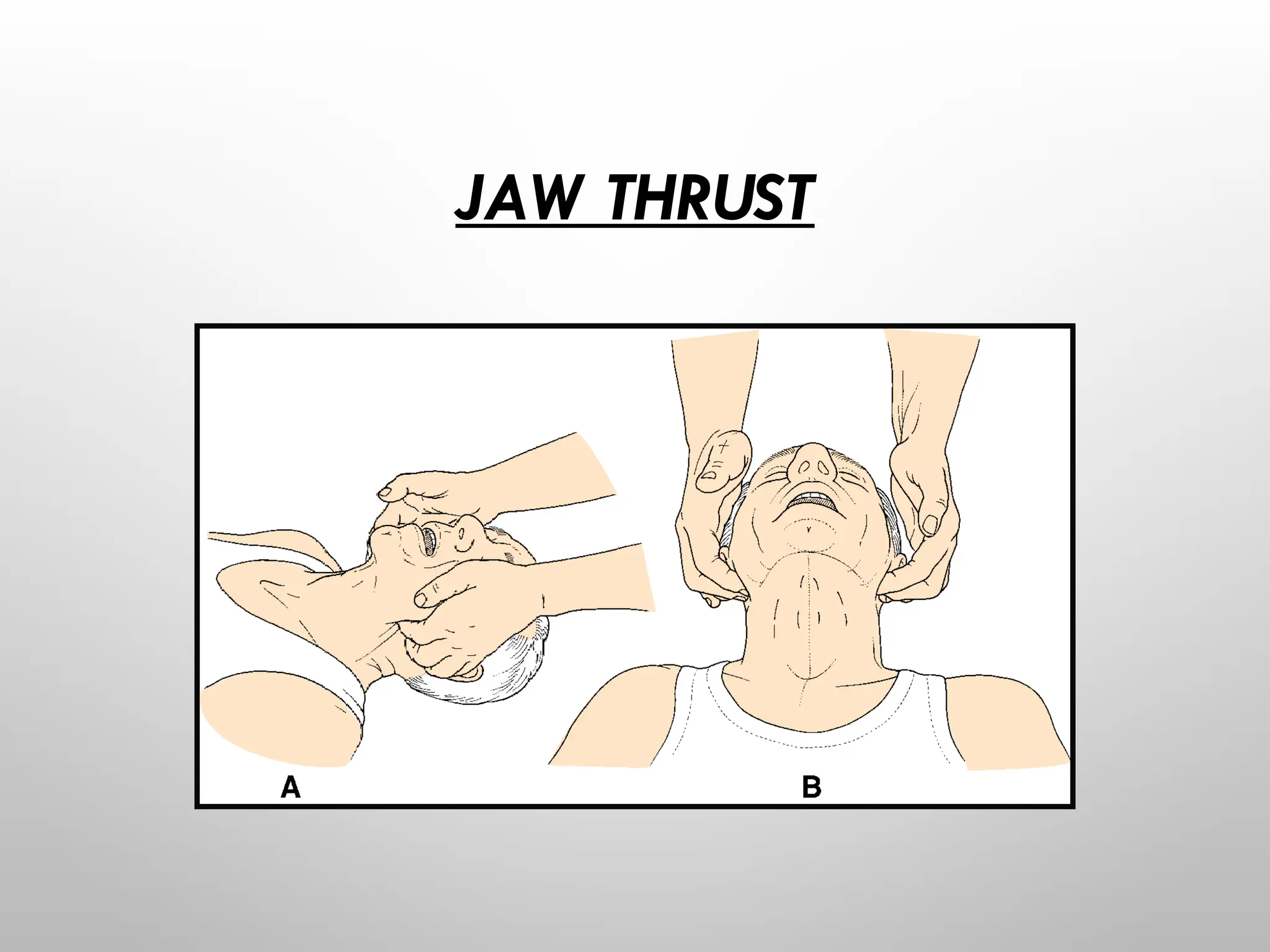 JAW THRUST
 