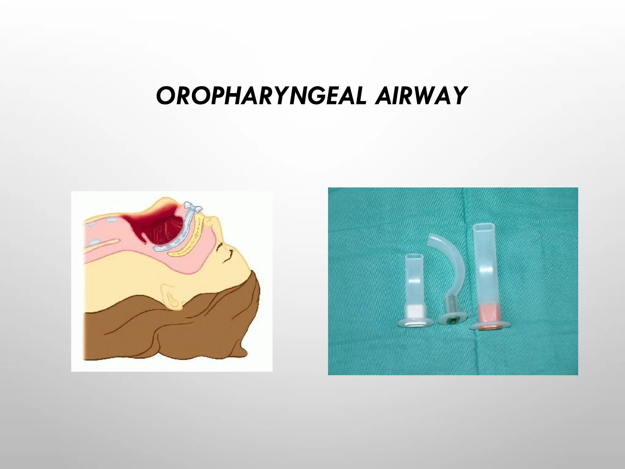 OROPHARYNGEAL AIRWAY
 