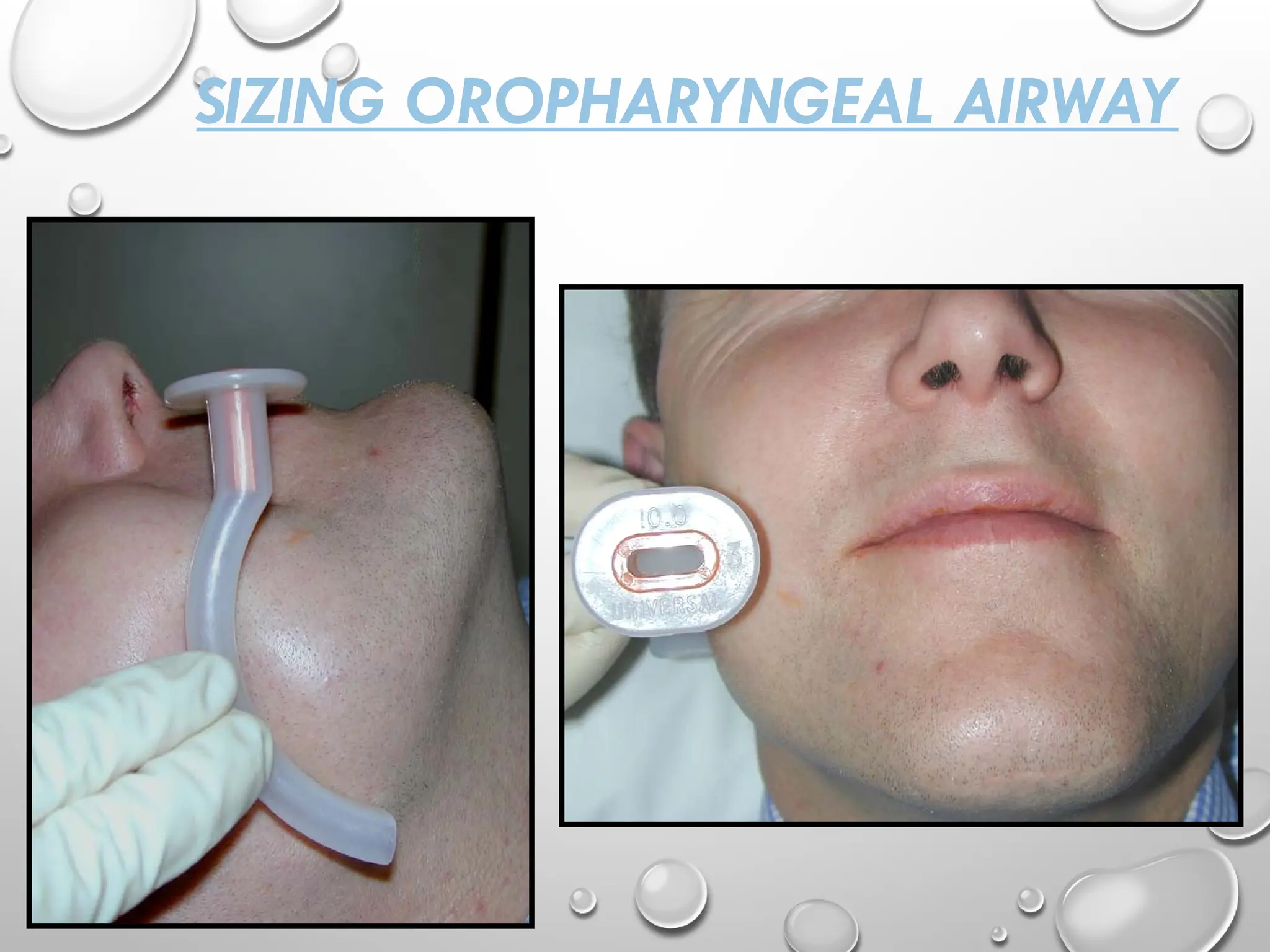 SIZING OROPHARYNGEAL AIRWAY
 