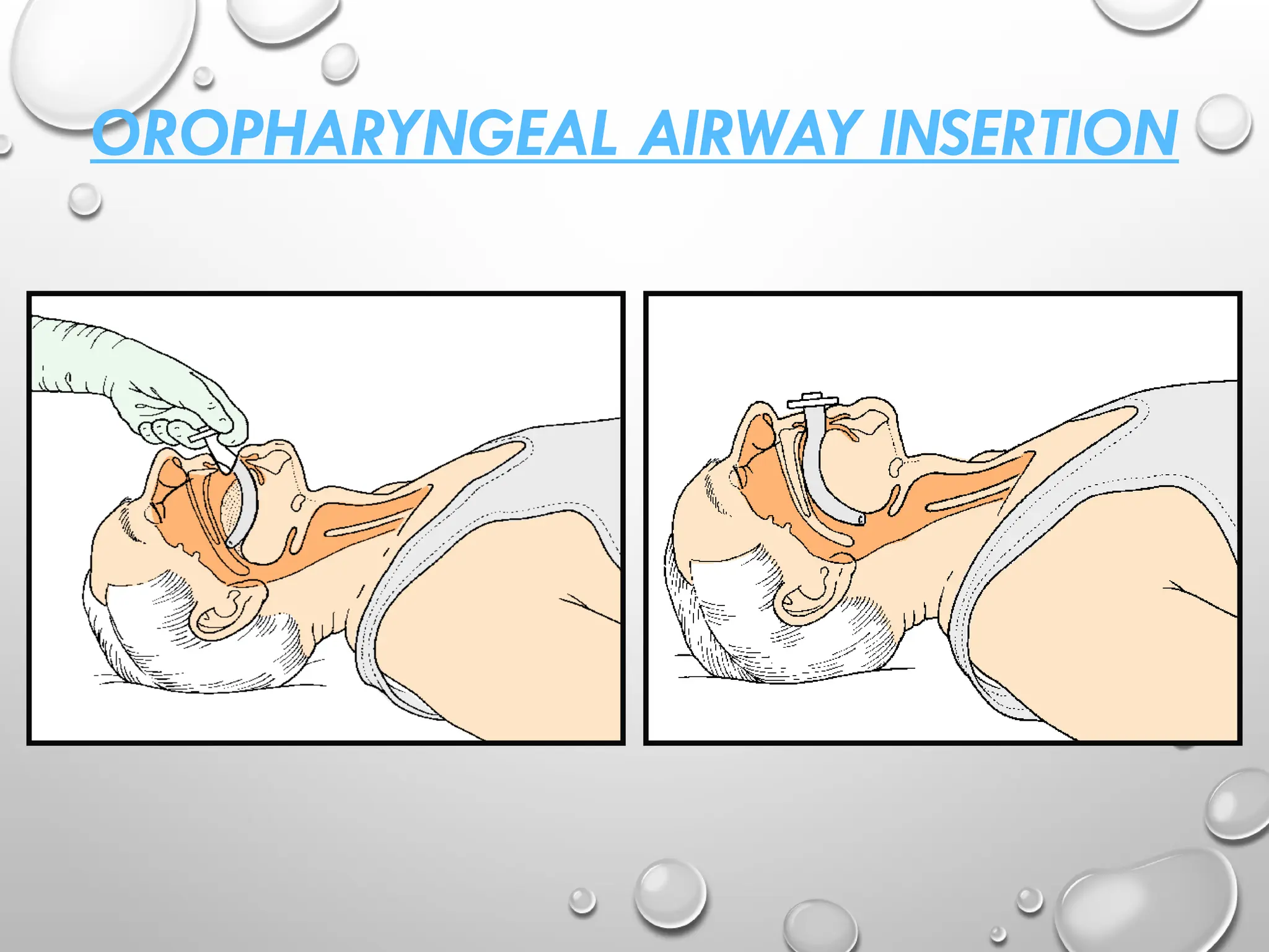 OROPHARYNGEAL AIRWAY INSERTION
 