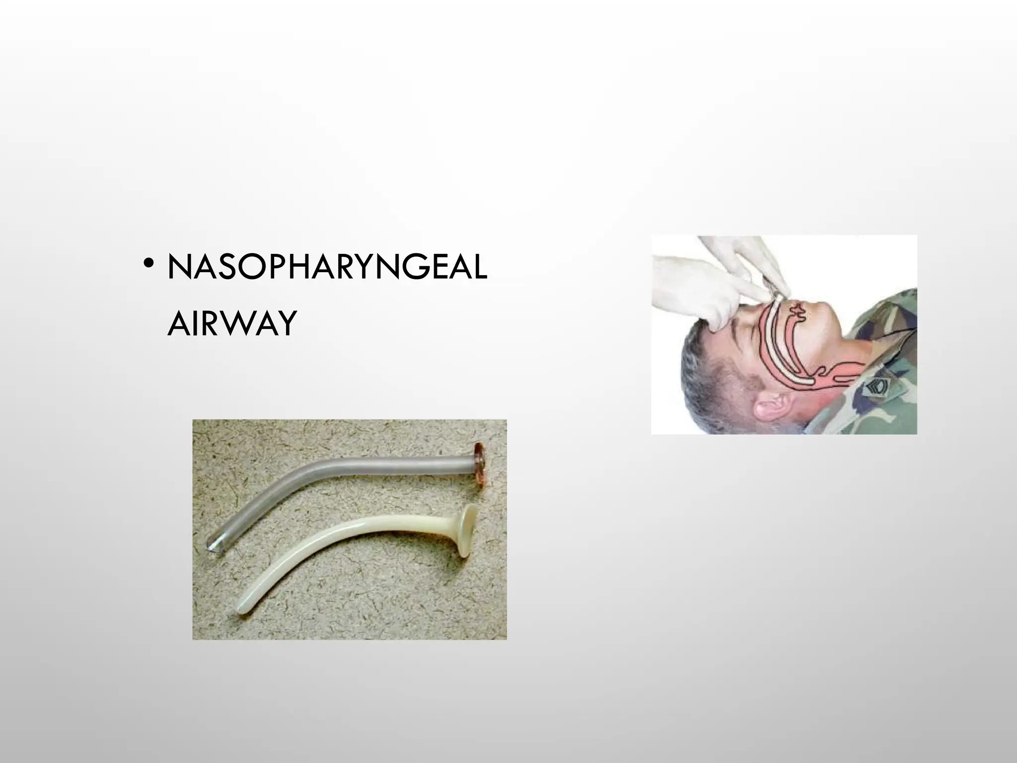 • NASOPHARYNGEAL
AIRWAY
 
