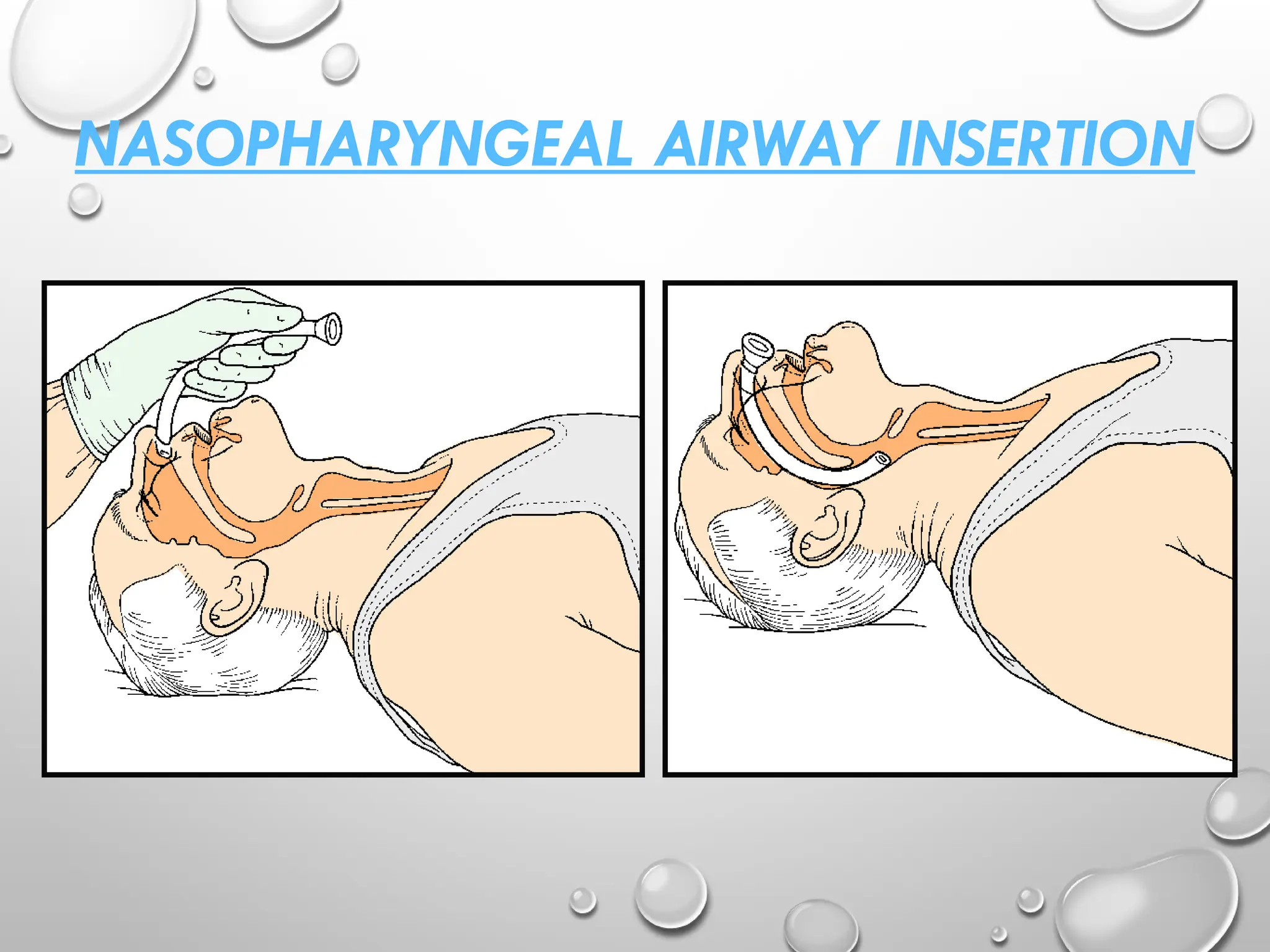 NASOPHARYNGEAL AIRWAY INSERTION
 